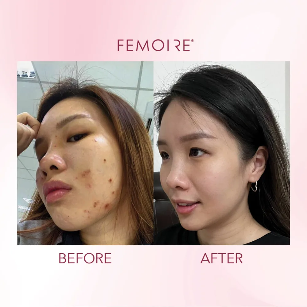 Femoire customer before & after — severe acne