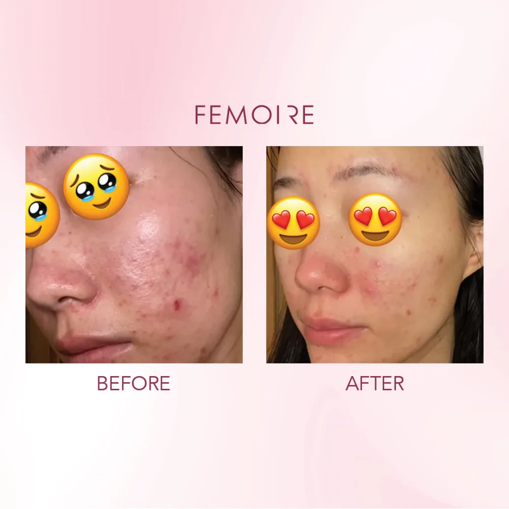 Femoire customer before & after — acne