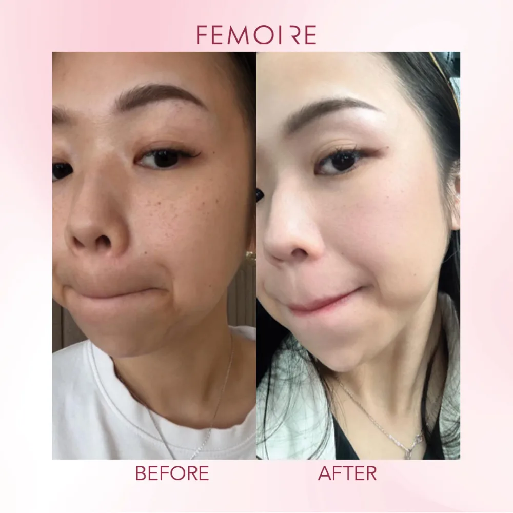 Femoire customer before & after — brightening & even tone