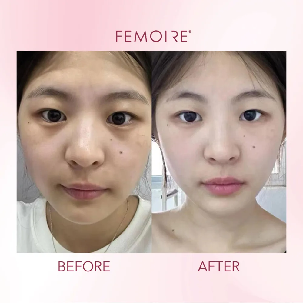 Femoire customer before & after — clear glow