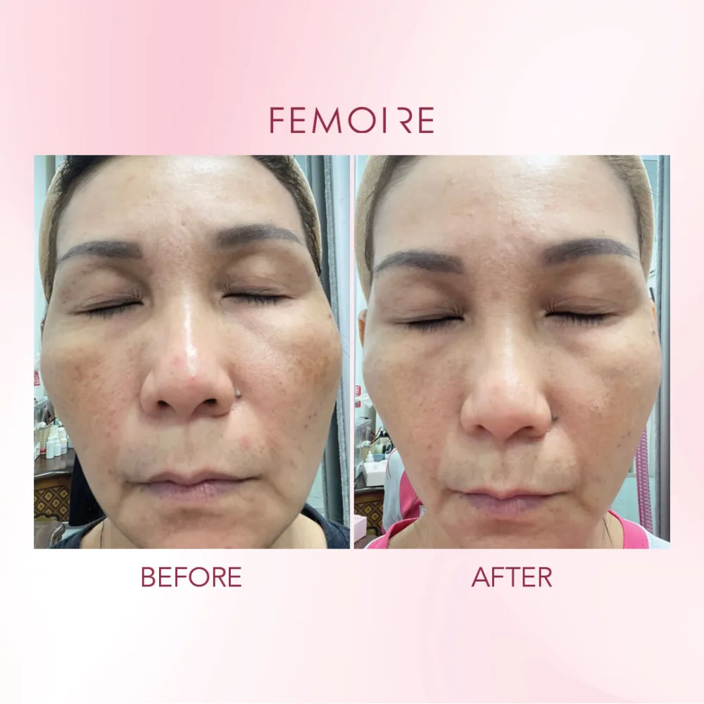 Femoire customer before & after — mature skin & fine lines