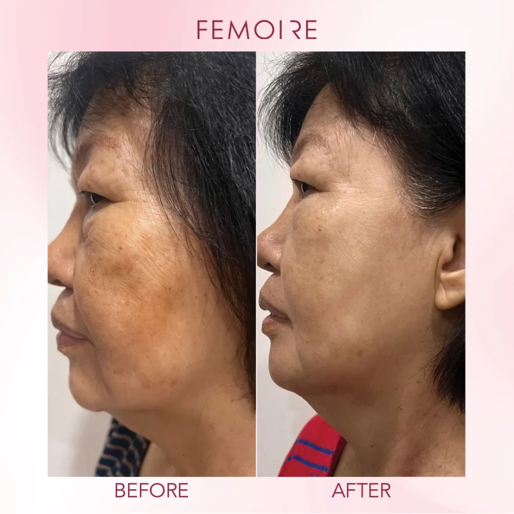 Femoire customer before & after — melasma & dark patches