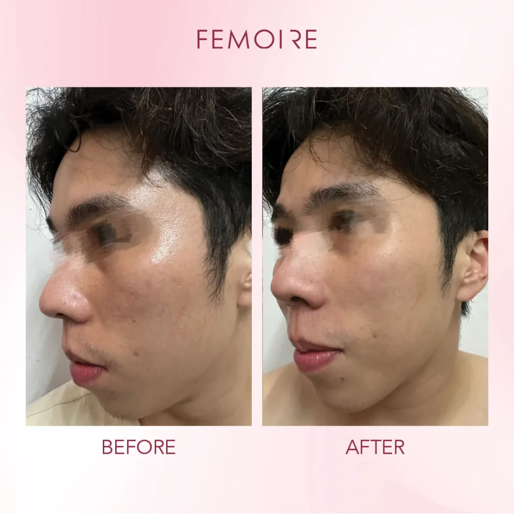 Femoire customer before & after — men’s skin