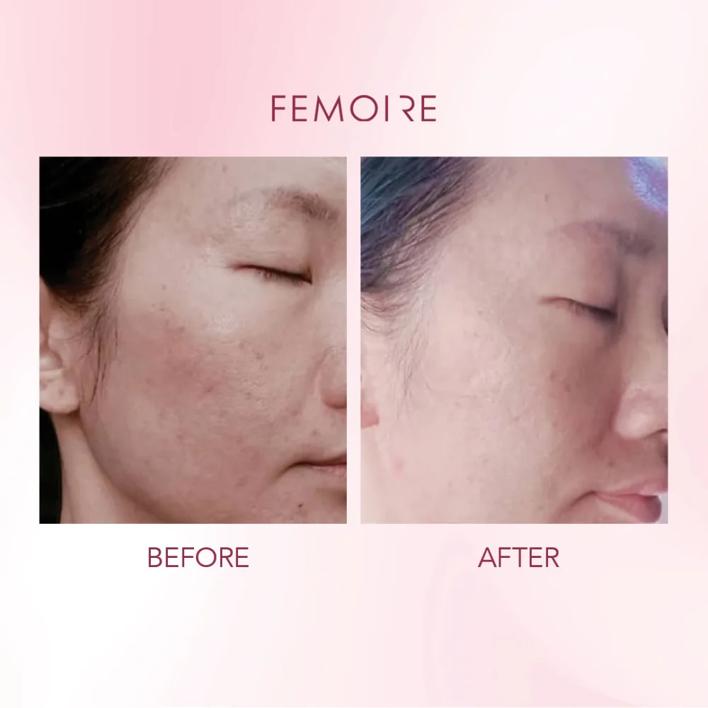 Femoire customer before & after — pigmentation