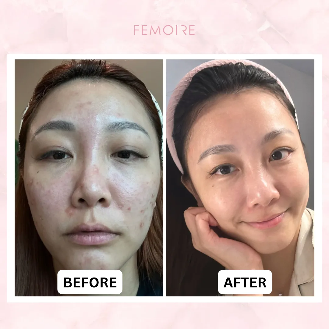 Femoire customer before & after