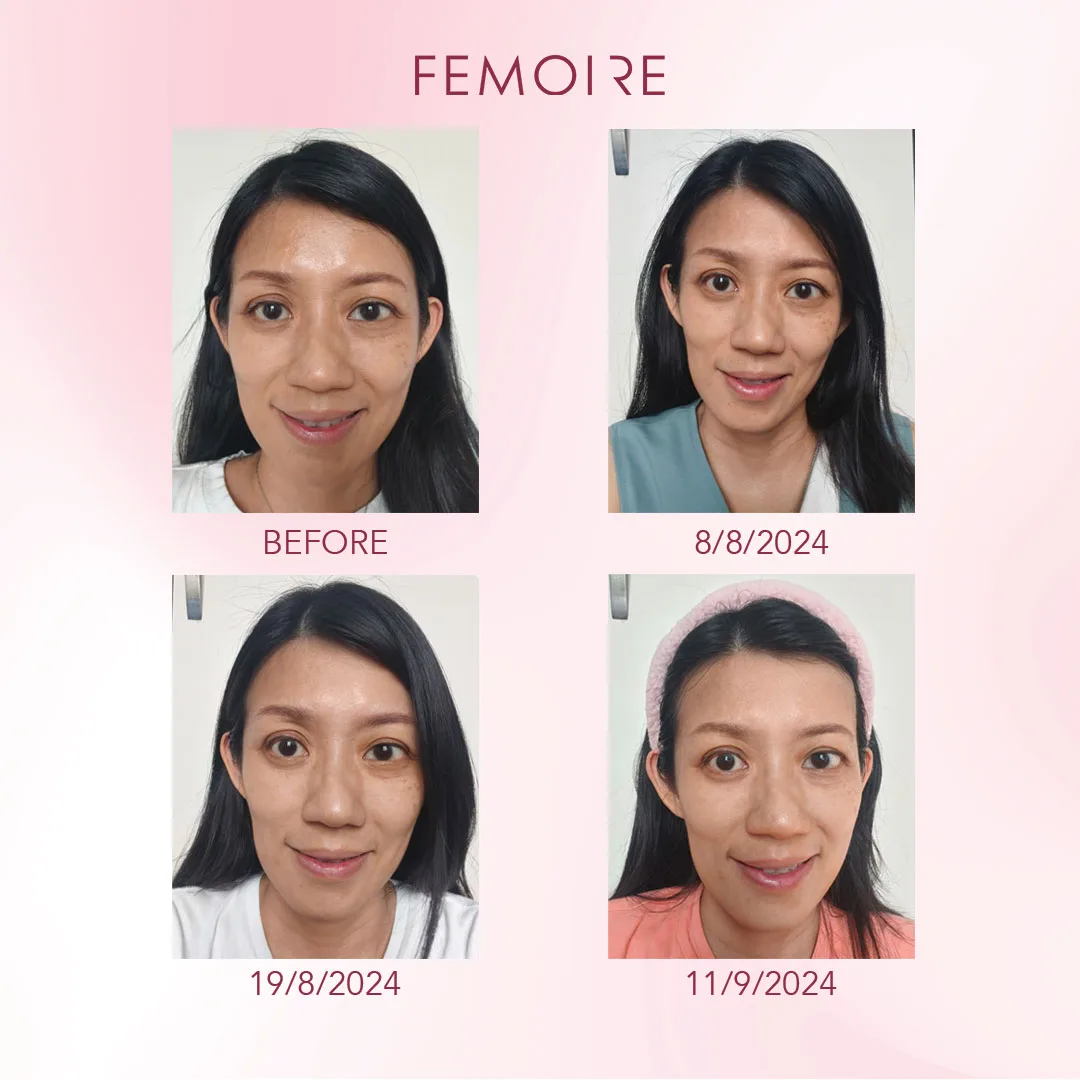 Femoire customer before & after — dated timeline