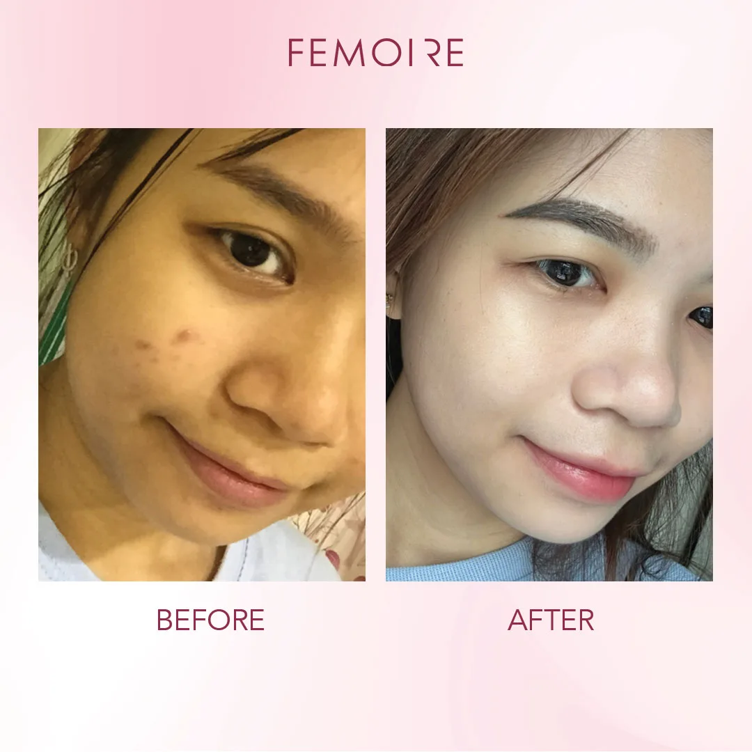Femoire customer before & after — glow