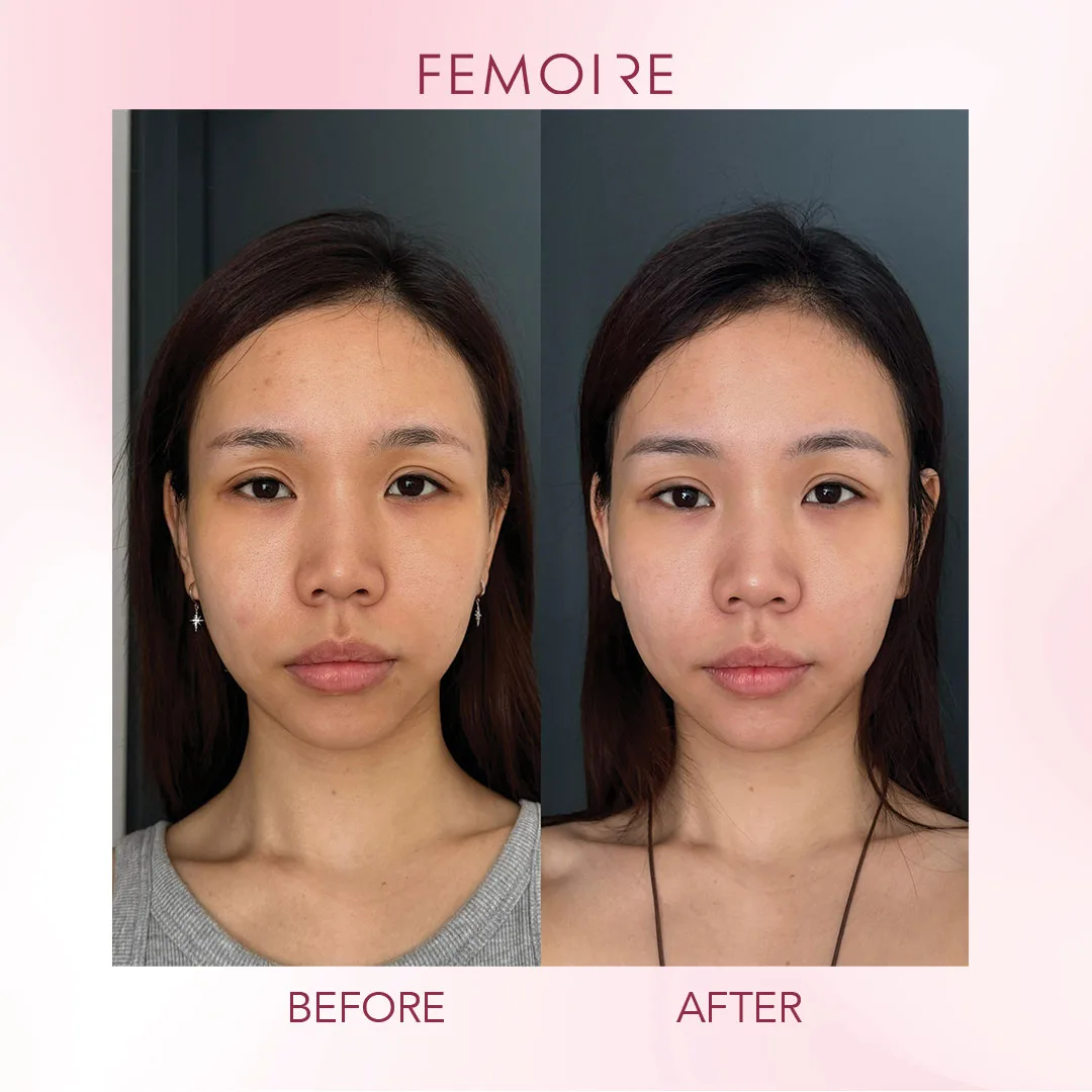 Femoire customer before & after — brightening