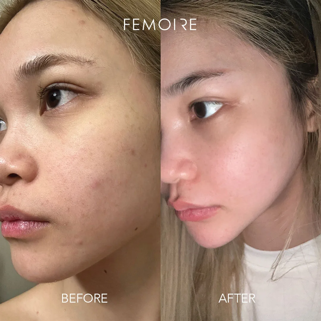 Femoire customer before & after — acne