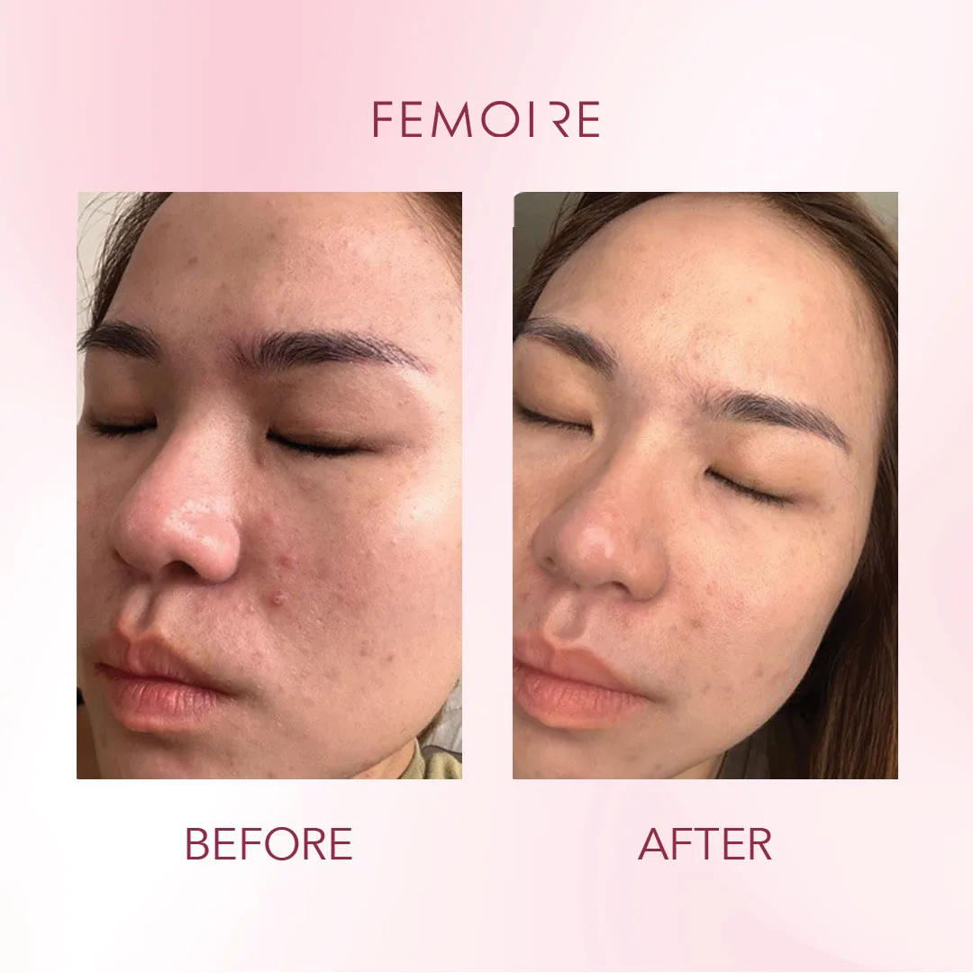 Femoire customer before & after — texture