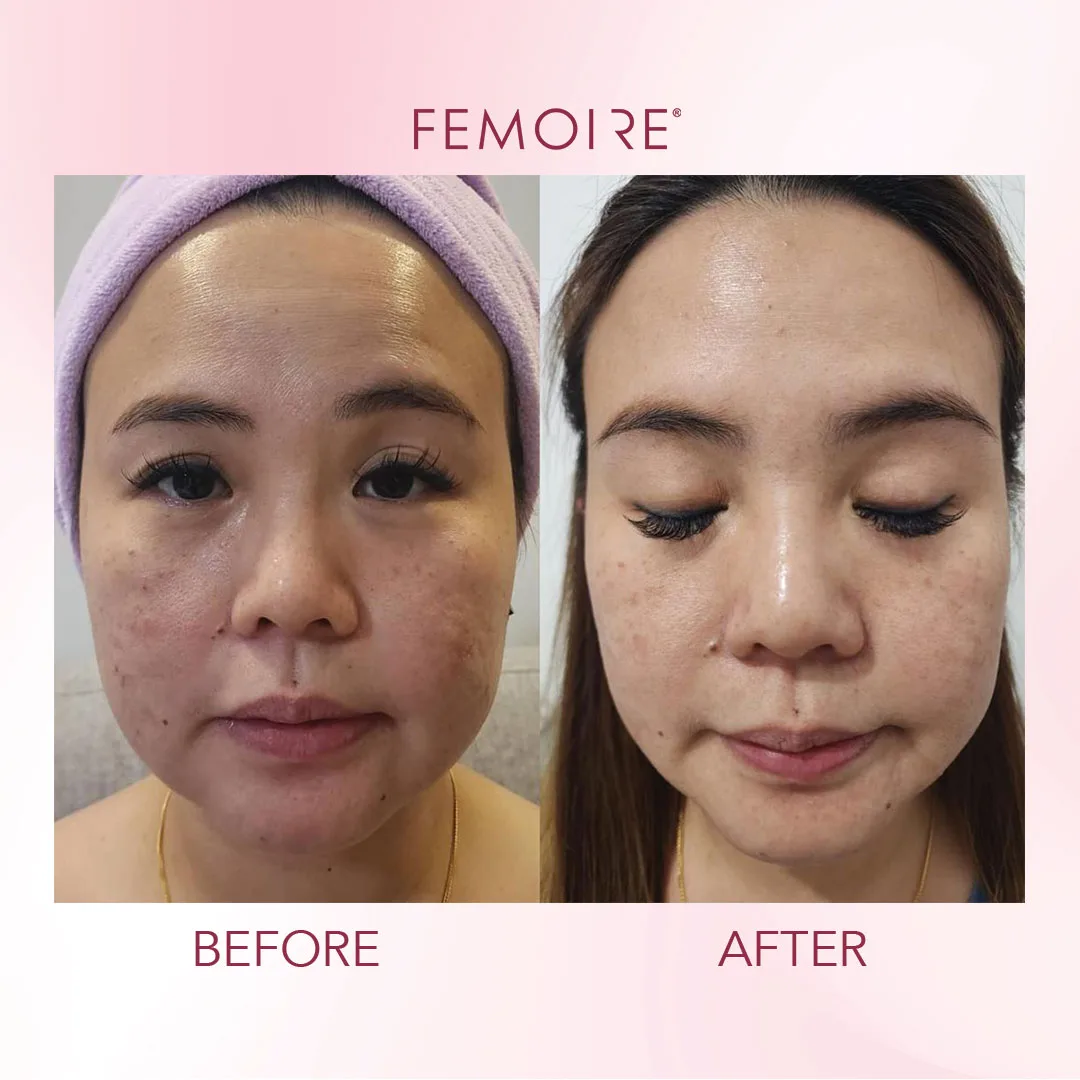 Femoire customer before & after — mature skin