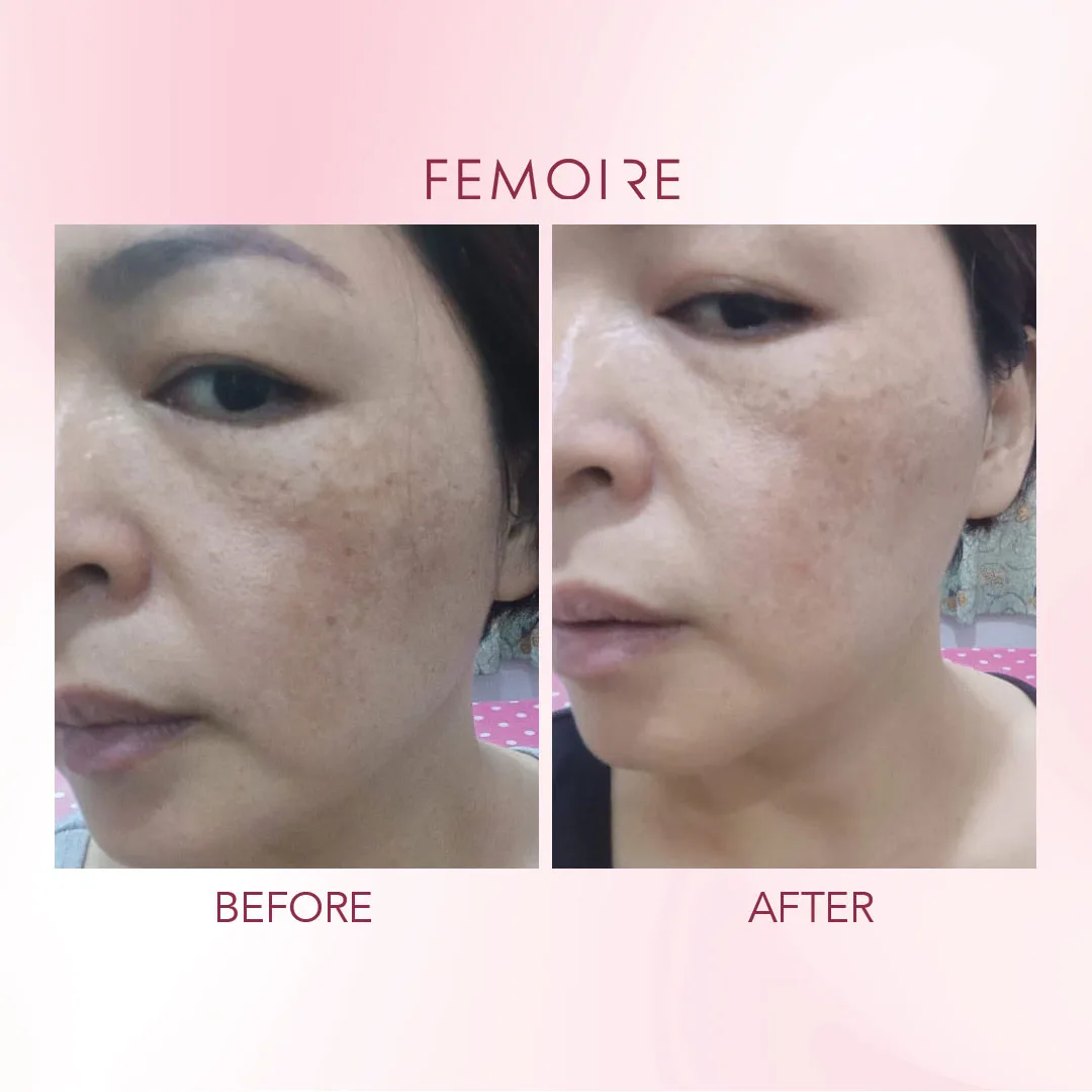 Femoire customer before & after — pigmentation