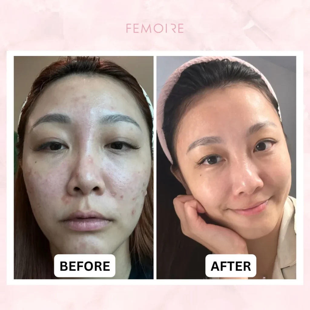 Femoire customer before & after